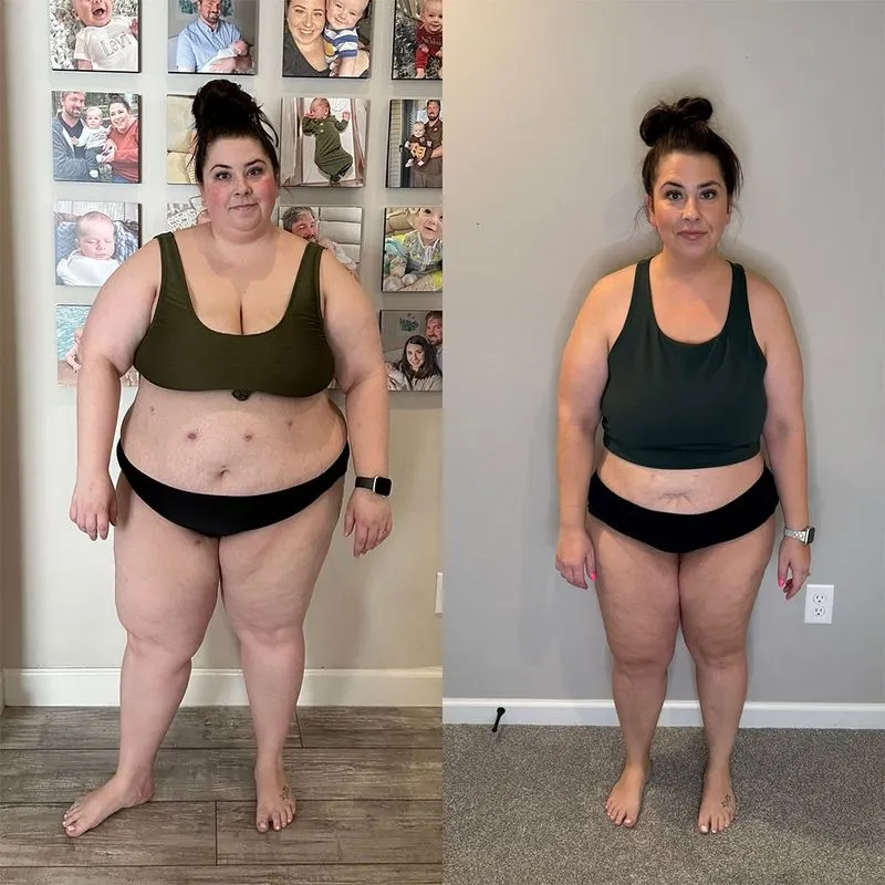 A patient before and after weight loss with GLP-1 treatment